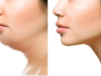 Liposuccion du double menton