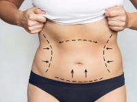 Abdominoplastie