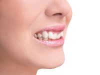 Malocclusion dentaire