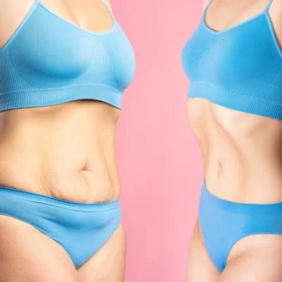 chirurgie_apres_perte_poids chirurgie_apres_perte_poids
