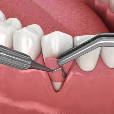 chirurgie_gingivale chirurgie_gingivale