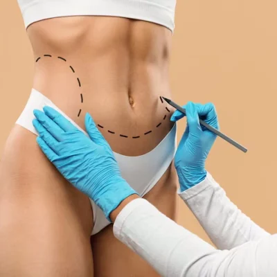 liposuccion_vaser liposuccion_vaser