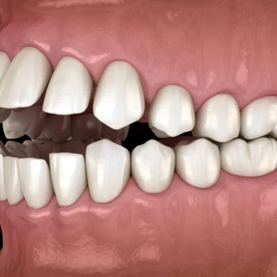 malocclusion_dentaire malocclusion_dentaire